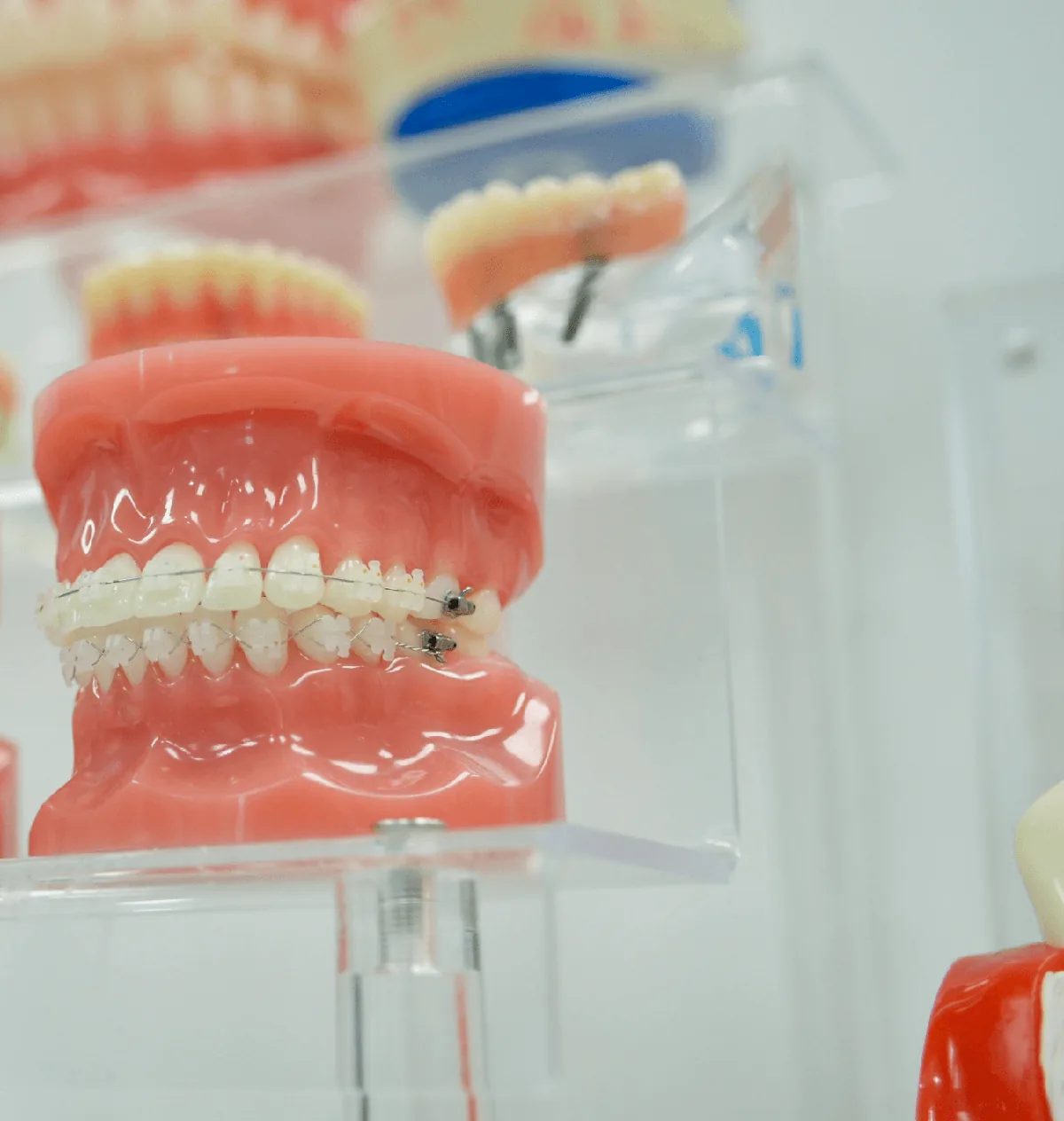 Dental Implants vs. Dentures: Pros and Cons in West Covina
