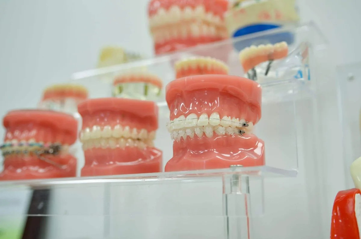 Close-up of orthodontic dental models with braces displayed on clear shelves inside a dental office.