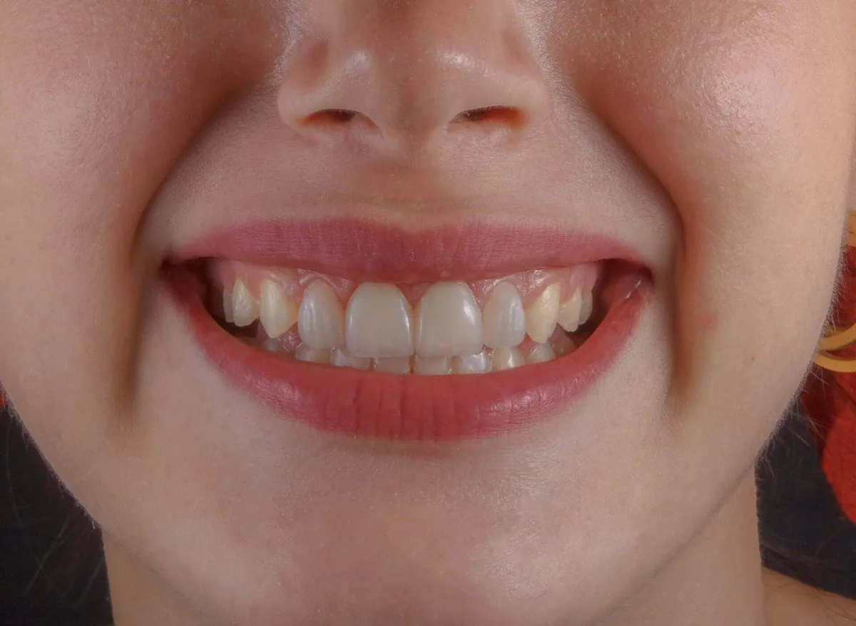 Foods and Drinks That Stain Your Teeth