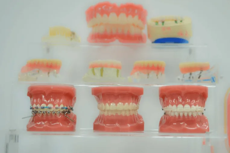 How Long Do Veneers Last vs Composite Bonding?