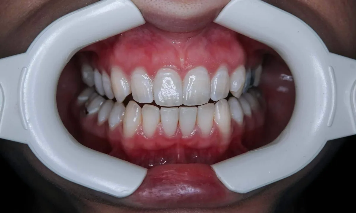 Composite bonding uses a tooth-colored resin that your dentist applies directly to the tooth