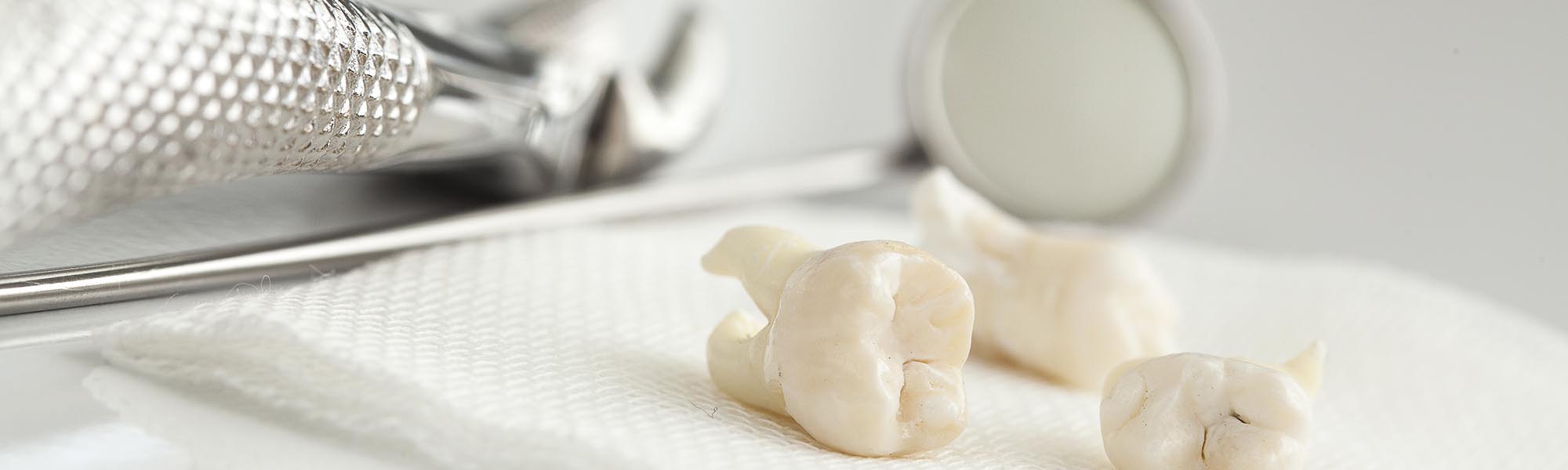 Tooth Extractions: 6 Ways to Prepare Yourself for Your Appointment