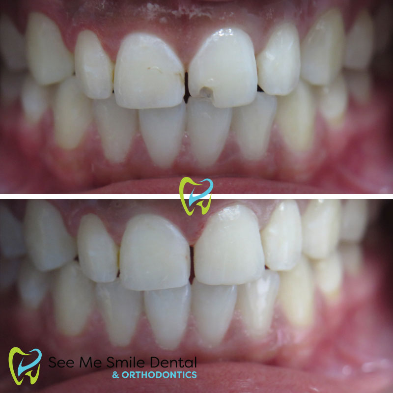 Dental Bonding West Covina