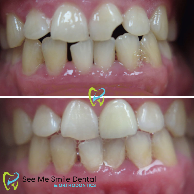 Porcelain Veneer Bonding West Covina