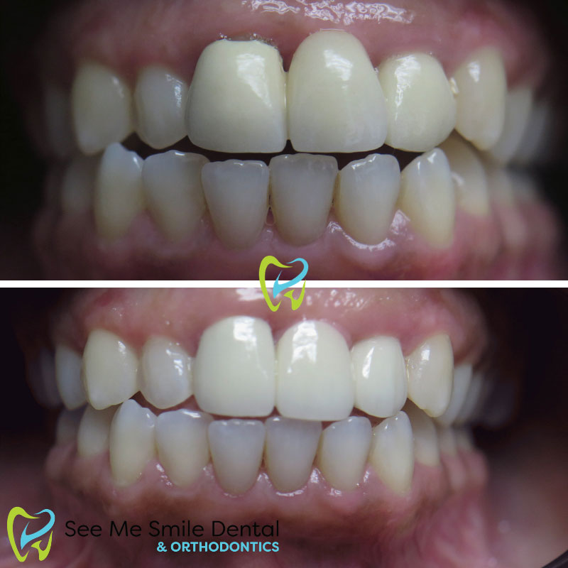 Crown Replacement West Covina