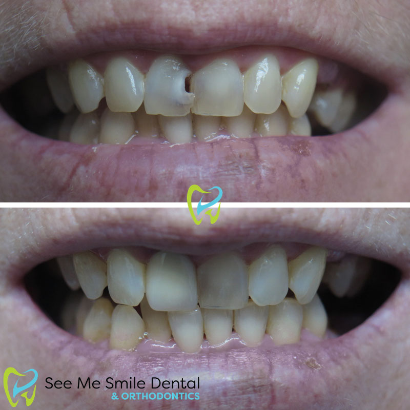 Dental Bonding West Covina
