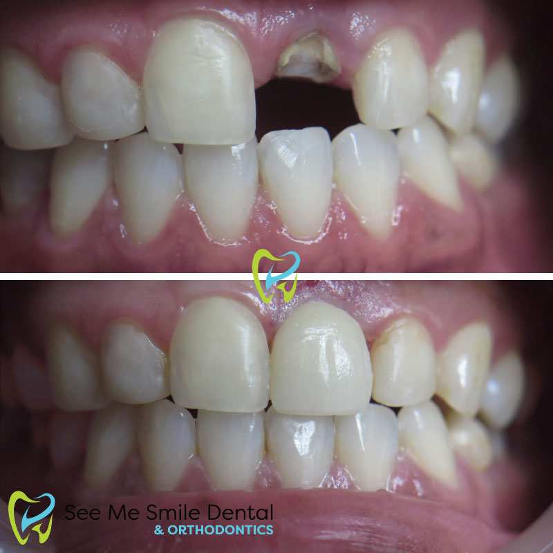 Same Day Emergency Tooth Extraction and Dental Implant West Covina