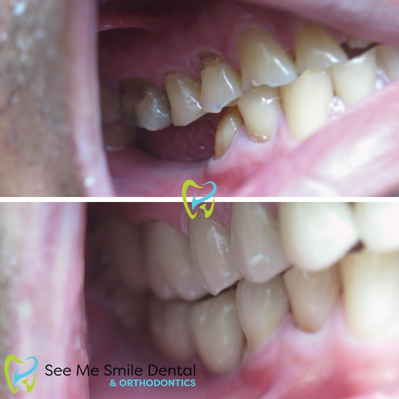 Implants and Veneers West Covina CA