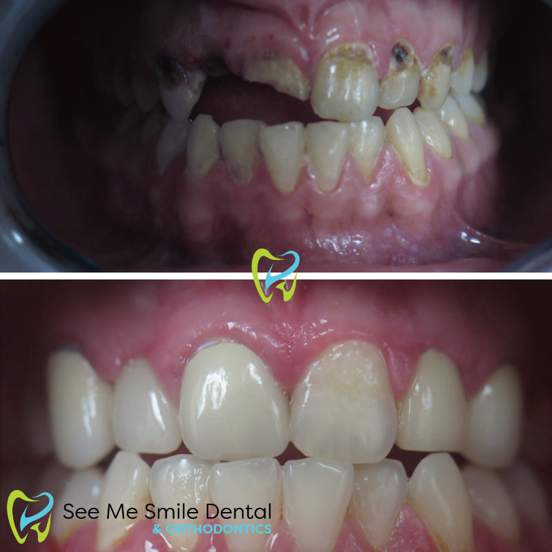 Implants, Crowns, and Veneers with Tooth Decay West Covina CA
