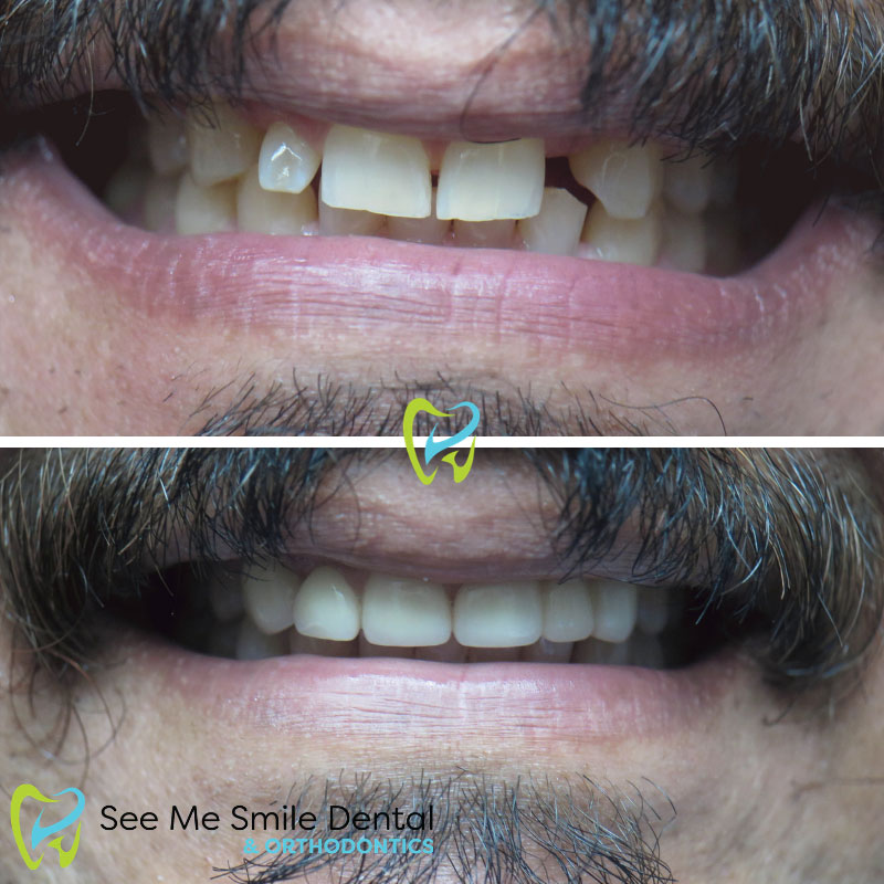 Dental Crowns West Covina CA