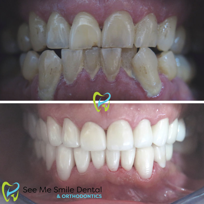 Porcelain Veneers West Covina CA