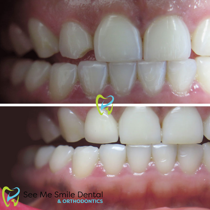 Chipped Tooth fixed by Veneers West Covina CA