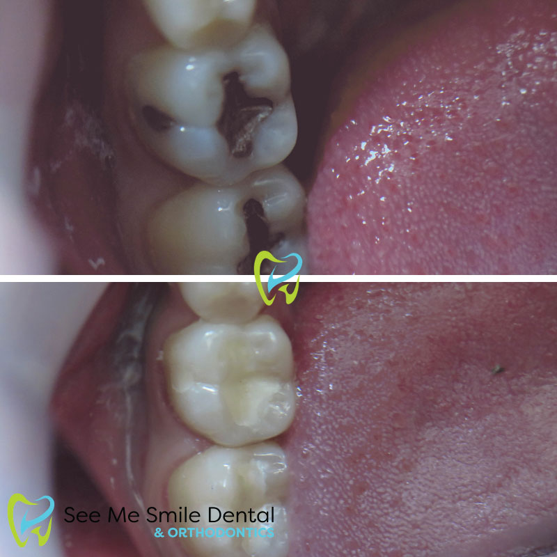 Dental Fillings West Covina