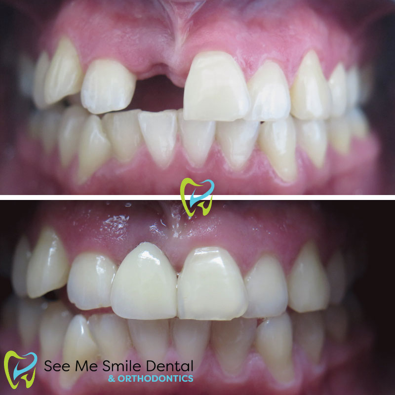 Dental Implant West Covina