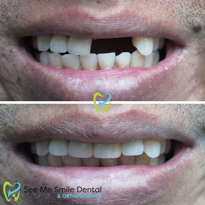 Dental Implants West Covina 