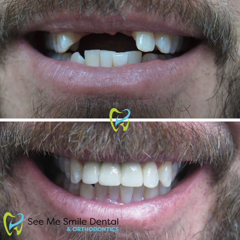 Dental Impalnts West Covina CA