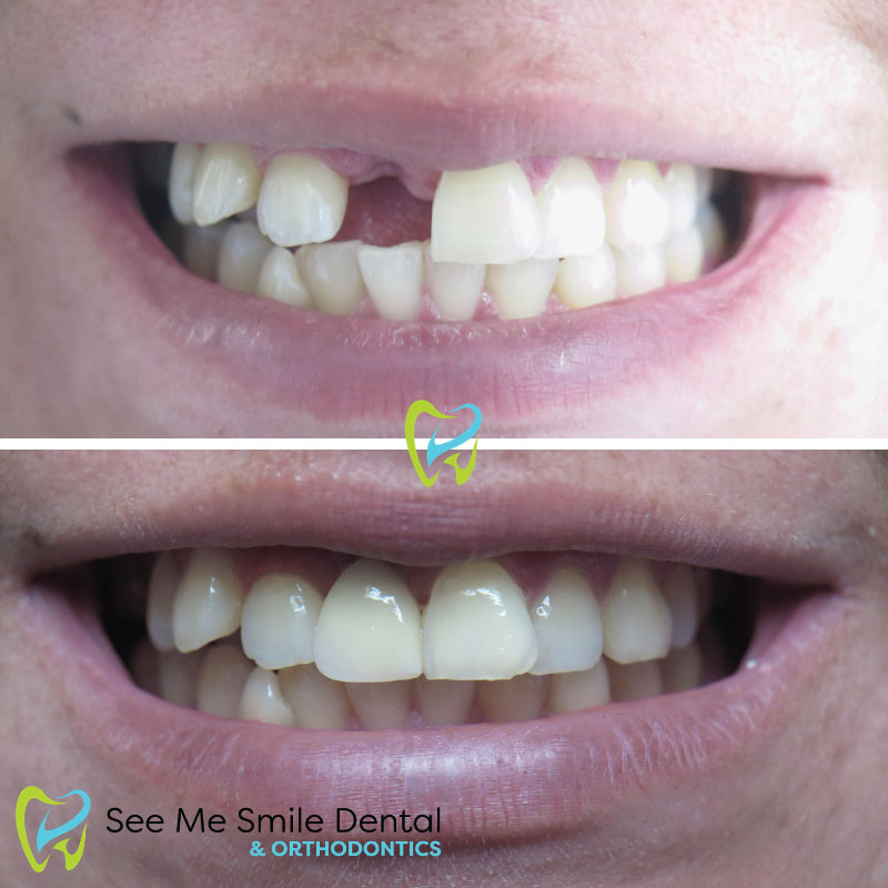Front Implants West Covina CA