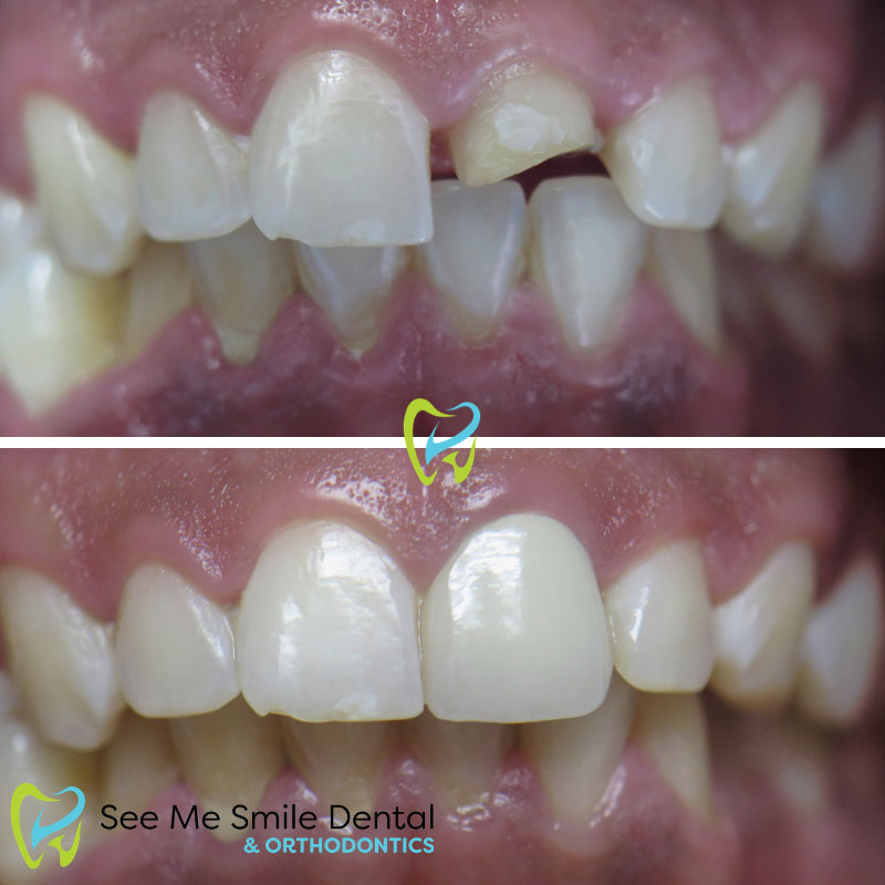 Front Veneer West Covina