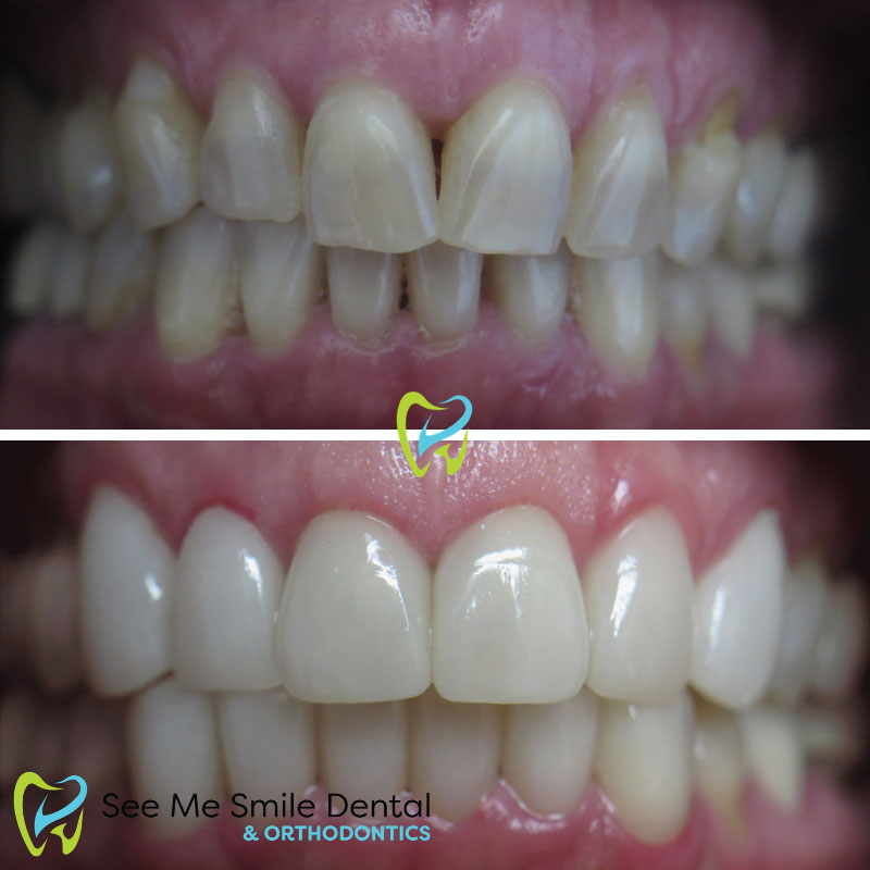 Full set of Veneers West Covina CA