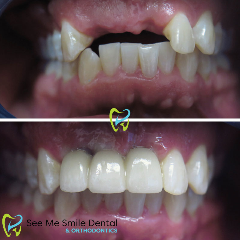 Implants and Dental Crowns West Covina CA