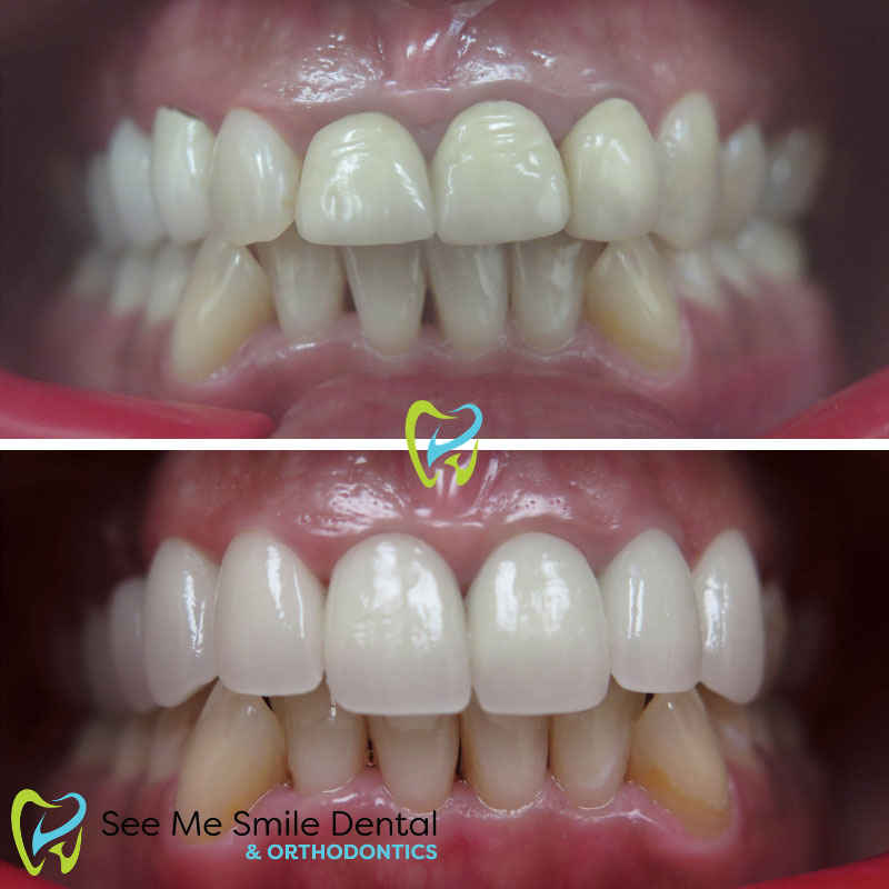 Veneers in West Covina CA