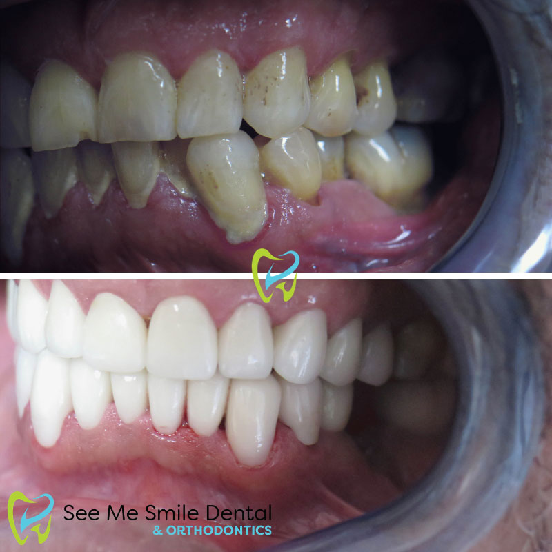 Side Teeth Veneers