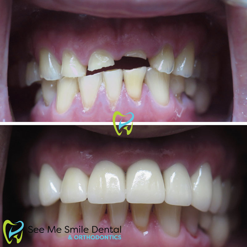 Veneers and Implants West Covina CA