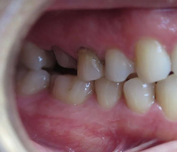 emergency dentist West Covina Before
