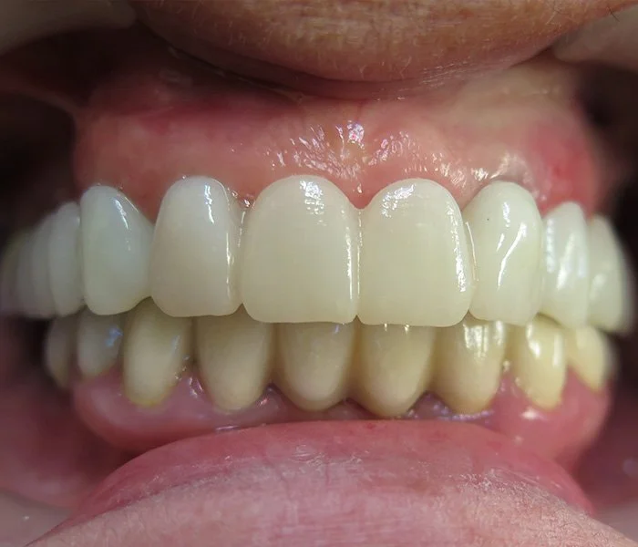 Dental Implants West Covina After
