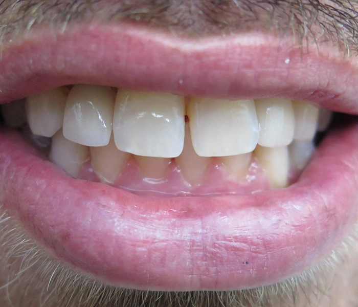emergency dentist West Covina After
