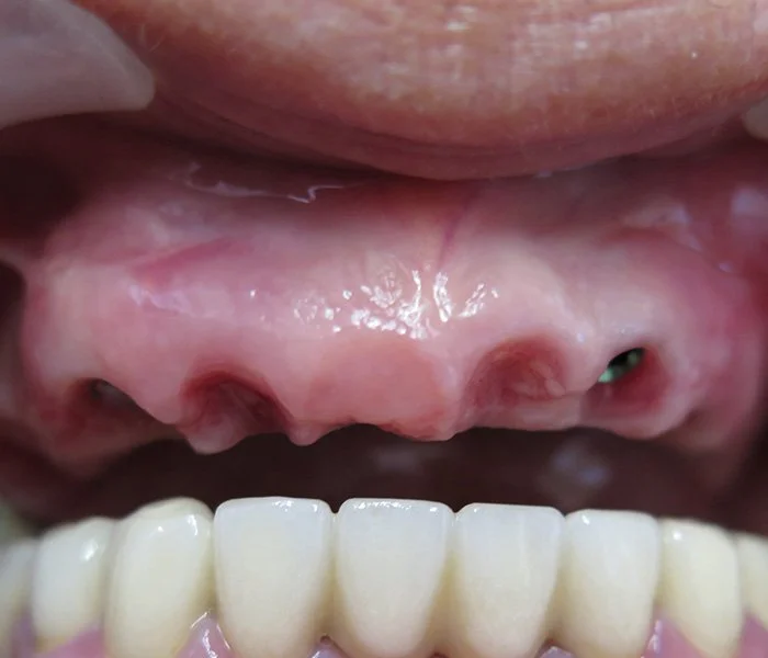Dental Implants West Covina Before
