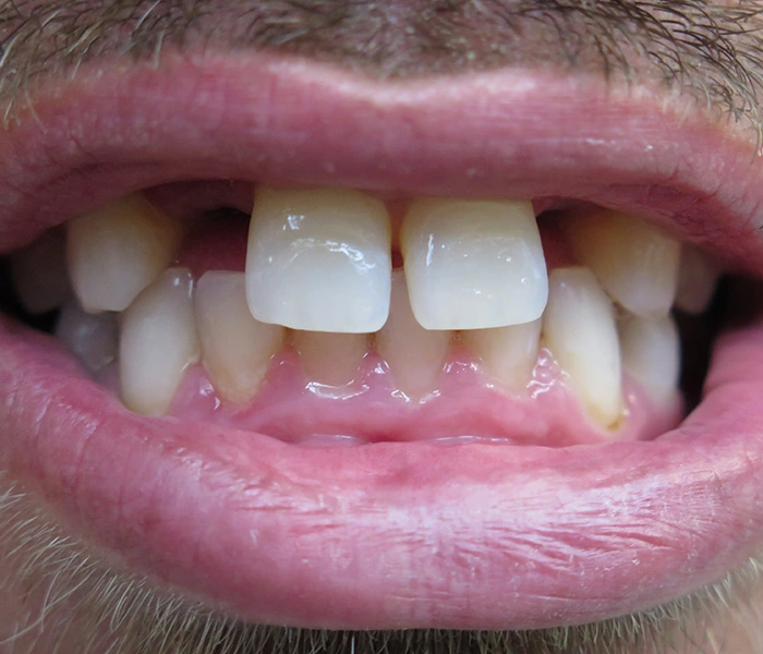 emergency dentist West Covina Before